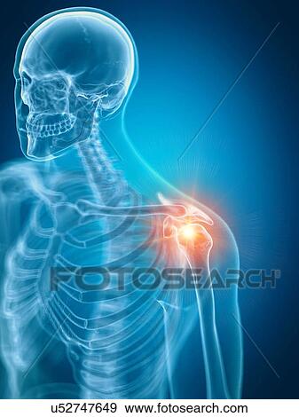 Illustration of a painful shoulder View Large Photo Image Stock Photo - Illustration of a painful shoulder. Fotosearch