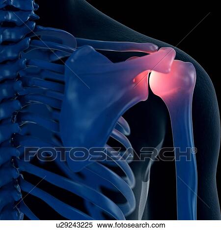 Stock Photography - Illustration of a painful shoulder. Fotosearch