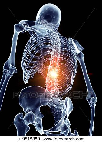 Stock Image - Illustration of a painful spine. Fotosearch