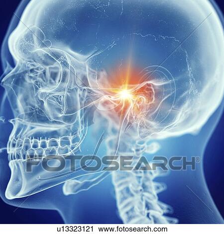 Stock Image - Illustration of a painful temporomandibular joint. Fotosearch