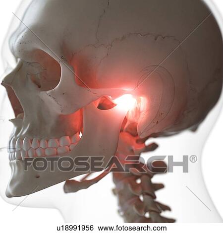 Stock Photograph - Illustration of a painful temporomandibular joint. Fotosearch