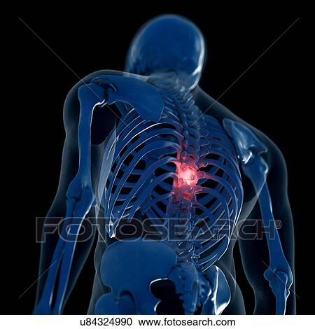 Stock Image - Illustration of a painful thoracic spine. Fotosearch