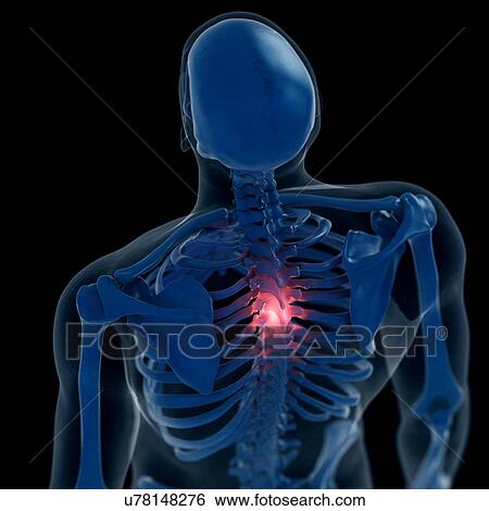 Illustration of a painful thoracic spine View Large Photo Image Stock Photograph - Illustration of a painful thoracic spine. Fotosearch
