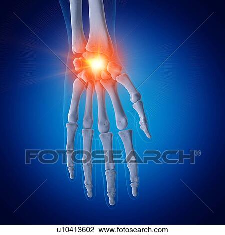 Stock Image - Illustration of a painful wrist. Fotosearch