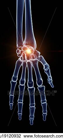 Illustration of a painful wrist View Large Photo Image Stock Image - Illustration of a painful wrist. Fotosearch
