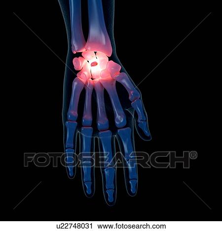 Illustration of a painful wrist View Large Photo Image Stock Image - Illustration of a painful wrist. Fotosearch