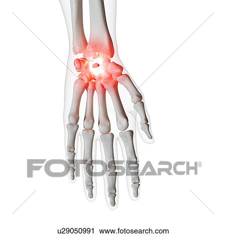 Stock Image - Illustration of a painful wrist. Fotosearch