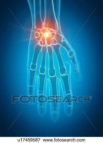 Stock Photo - Illustration of a painful wrist. Fotosearch