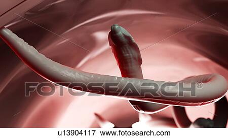 Stock Photo - Illustration of a roundworm in a human colon. Fotosearch