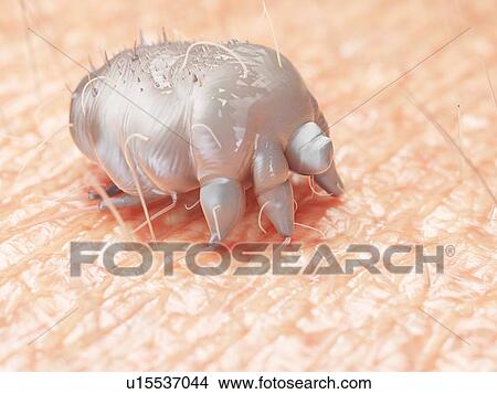 Picture - Illustration of a scabies mite on human skin. Fotosearch