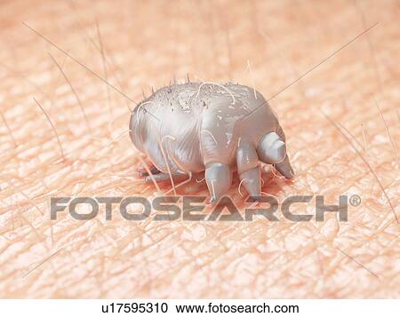 Stock Image - Illustration of a scabies mite on human skin. Fotosearch