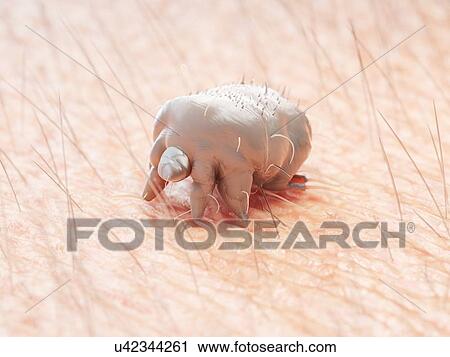 Stock Image - Illustration of a scabies mite on human skin. Fotosearch