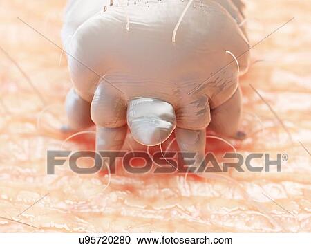 Stock Image - Illustration of a scabies mite on human skin. Fotosearch