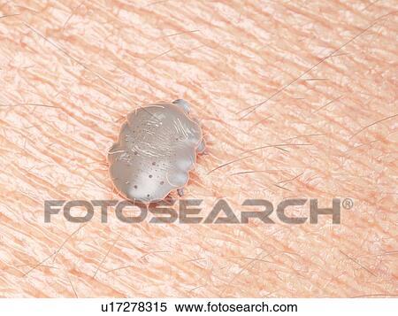 Stock Photography - Illustration of a scabies mite on human skin. Fotosearch