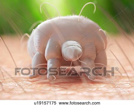 Stock Photography - Illustration of a scabies mite on human skin. Fotosearch