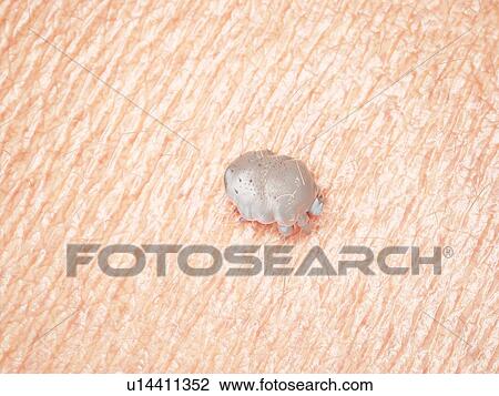 Stock Image - Illustration of a scabies mite. Fotosearch