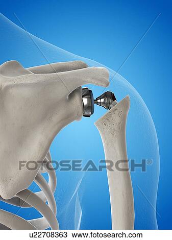 Stock Image - Illustration of a shoulder replacement. Fotosearch