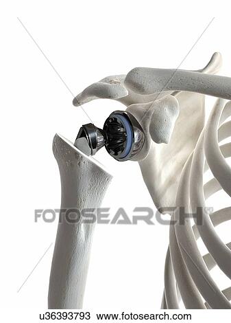 Stock Image - Illustration of a shoulder replacement. Fotosearch