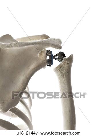 Stock Photo - Illustration of a shoulder replacement. Fotosearch