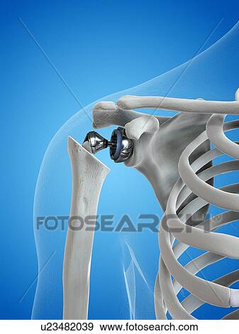 Illustration of a shoulder replacement View Large Photo Image Stock Photo - Illustration of a shoulder replacement. Fotosearch