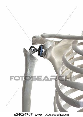 Stock Photo - Illustration of a shoulder replacement. Fotosearch