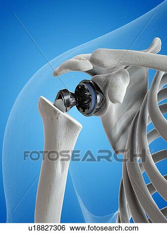Stock Photograph - Illustration of a shoulder replacement. Fotosearch