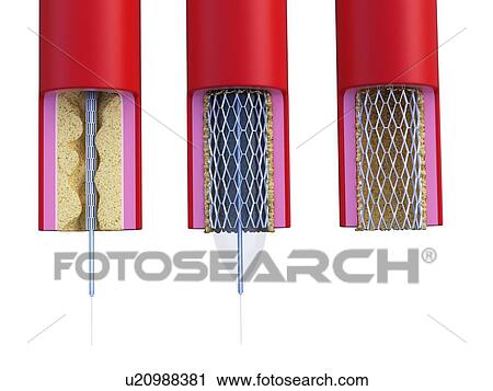 Stock Image - Illustration of a stent being placed. Fotosearch