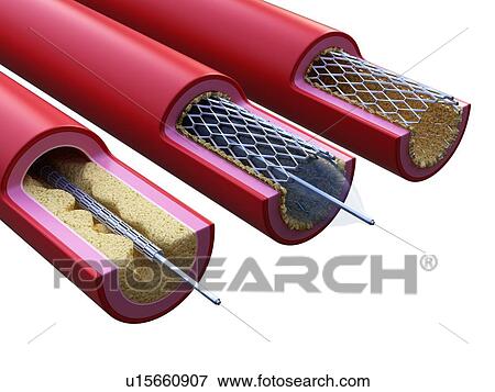 Stock Photo - Illustration of a stent being placed. Fotosearch