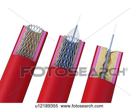 Illustration of a stent being placed View Large Photo Image Stock Photography - Illustration of a stent being placed. Fotosearch