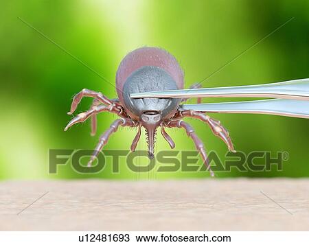 Stock Image - Illustration of a tick being removed. Fotosearch