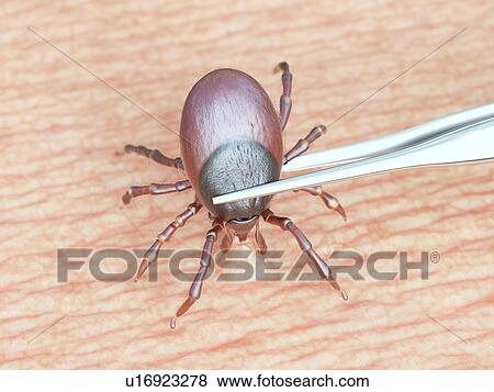 Illustration of a tick being removed View Large Photo Image Stock Photo - Illustration of a tick being removed. Fotosearch