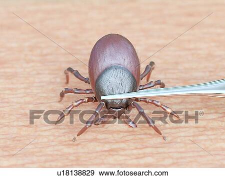 Stock Photo - Illustration of a tick being removed. Fotosearch