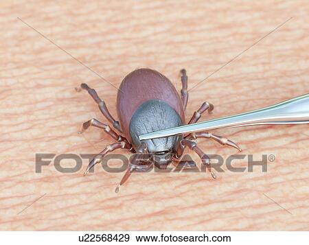 Stock Photo - Illustration of a tick being removed. Fotosearch