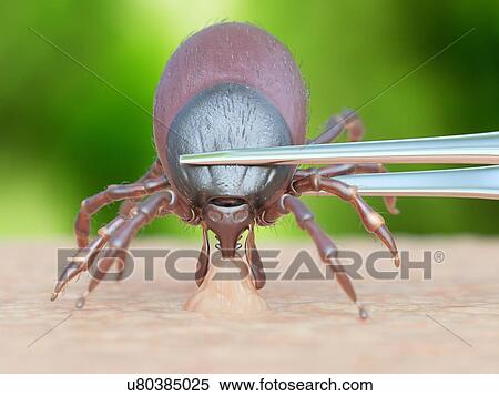 Stock Photography - Illustration of a tick being removed. Fotosearch