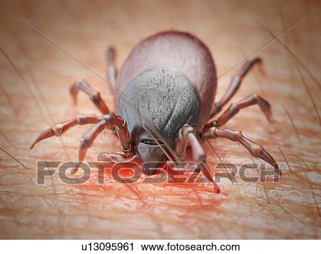 Illustration of a tick biting human skin View Large Photo Image Stock Image - Illustration of a tick biting human skin. Fotosearch