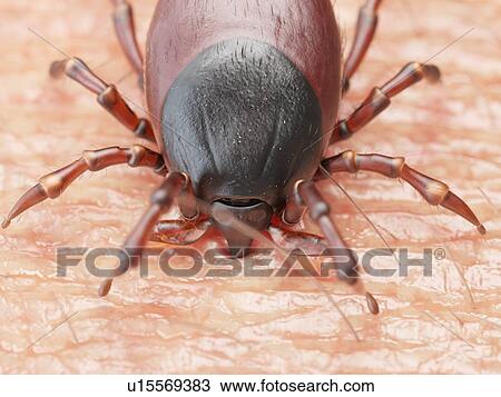 Stock Image - Illustration of a tick biting human skin. Fotosearch