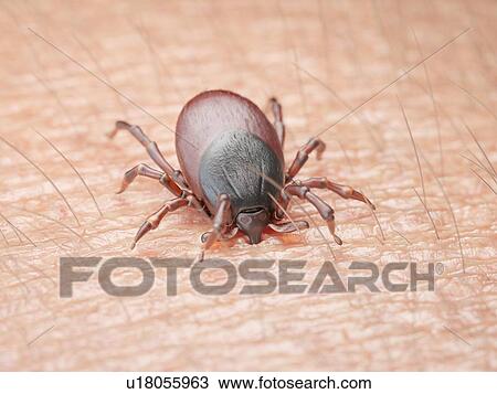 Stock Image - Illustration of a tick biting human skin. Fotosearch