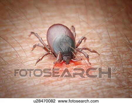 Illustration of a tick biting human skin View Large Photo Image Stock Image - Illustration of a tick biting human skin. Fotosearch