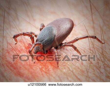 Illustration of a tick biting human skin View Large Photo Image Stock Photograph - Illustration of a tick biting human skin. Fotosearch