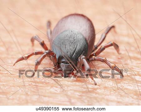 Stock Photography - Illustration of a tick biting human skin. Fotosearch