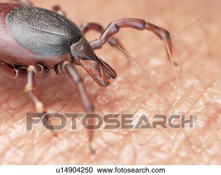 Stock Image - Illustration of a tick crawling on human skin. Fotosearch