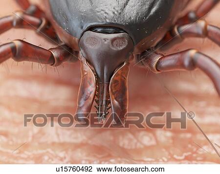 Stock Image - Illustration of a tick crawling on human skin. Fotosearch