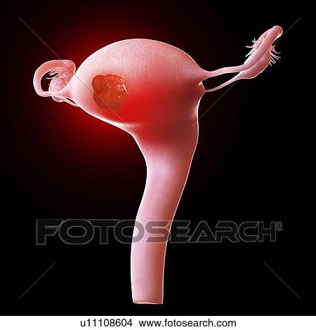 Picture - Illustration of a uterus tumour. Fotosearch