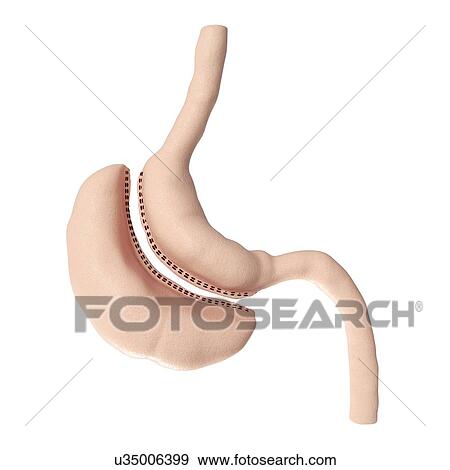 Illustration of a vertical sleeve gastrectomy View Large Photo Image Stock Photo - Illustration of a vertical sleeve gastrectomy. Fotosearch