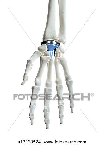 Picture - Illustration of a wrist replacement. Fotosearch