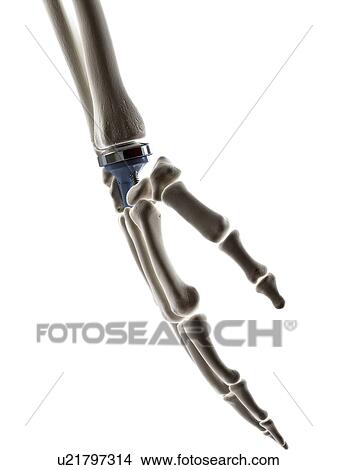Picture - Illustration of a wrist replacement. Fotosearch