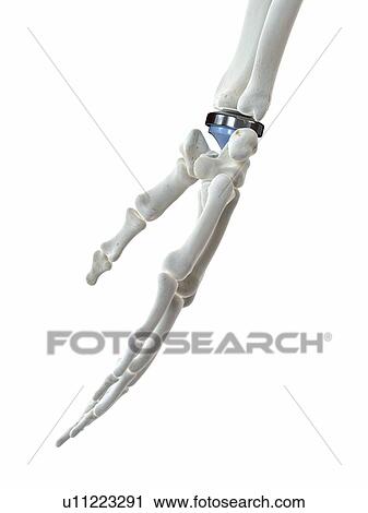 Stock Image - Illustration of a wrist replacement. Fotosearch