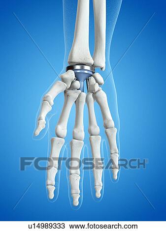 Stock Image - Illustration of a wrist replacement. Fotosearch