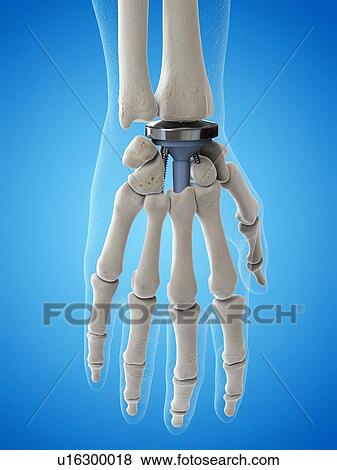 Stock Photo - Illustration of a wrist replacement. Fotosearch