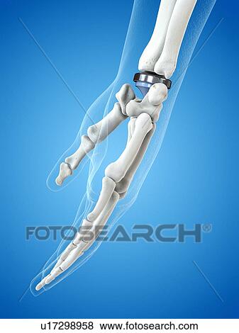 Stock Photo - Illustration of a wrist replacement. Fotosearch